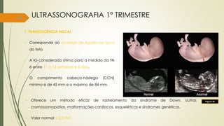 39
1. TRANSLUCÊNCIA NUCAL
• Corresponde ao acúmulo de líquido na nuca
do feto
• A IG considerada ótima para a medida da TN
é entre 11 a 13 semanas e 6 dias.
• O comprimento cabeça-nádega (CCN)
mínimo é de 45 mm e o máximo de 84 mm.
ULTRASSONOGRAFIA 1° TRIMESTRE
Figura 26
• Oferece um método eficaz de rastreamento da síndrome de Down, outras
cromossomopatias, malformações cardíacas, esqueléticas e síndromes genéticas.
• Valor normal ≤ 2,5 mm
 