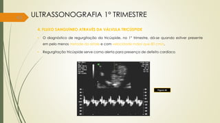 43
4. FLUXO SANGUÍNEO ATRAVÉS DA VÁLVULA TRICÚSPIDE
• O diagnóstico de regurgitação da tricúspide, no 1° trimestre, dá-se quando estiver presente
em pelo menos metade da sístole e com velocidade maior que 80 cm/s.
• Regurgitação tricúspide serve como alerta para presença de defeito cardíaco
Figura 30
ULTRASSONOGRAFIA 1° TRIMESTRE
 