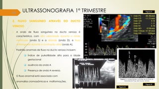 44
5. FLUXO SANGUÍNEO ATRAVÉS DO DUCTO
VENOSO
• A onda de fluxo sanguíneo no ducto venoso é
característica, com alta velocidade durante a sístole
ventricular (onda S) e a diástole (onda D), e fluxo
anterógrado durante a contração atrial (onda A).
• Padrões anormais de fluxo no ducto venoso incluem:
 Índice de pulsatilidade alta para a idade
gestacional
 ausência da onda A
 Presença de onda A reversa.
• O fluxo anormal está associado com
• anomalias cromossômicas e malformações.
ULTRASSONOGRAFIA 1° TRIMESTRE Figura 31
Figura 32
Figura 33
 