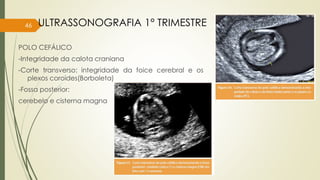 POLO CEFÁLICO
-Integridade da calota craniana
-Corte transverso: integridade da foice cerebral e os
plexos coroides(Borboleta)
-Fossa posterior:
cerebelo e cisterna magna
46 ULTRASSONOGRAFIA 1° TRIMESTRE
 
