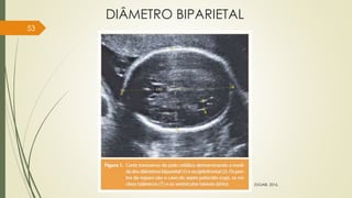 DIÂMETRO BIPARIETAL
53
ZUGAIB, 2016.
 
