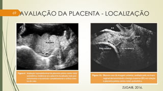 AVALIAÇÃO DA PLACENTA - LOCALIZAÇÃO
69
ZUGAIB, 2016.
 