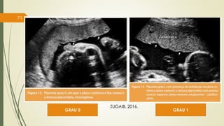 GRAU 0 GRAU 1
71
ZUGAIB, 2016.
 