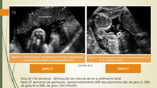 GRAU 2 GRAU 3
72
ZUGAIB, 2016.
Grau III < 34 semanas - diminuição do volume de LA e sofrimento fetal;
Após 37 semanas de gestação, aproximadamente 60% das placentas são de grau II; 20%,
de grau III; e 20%, de grau I (HC-FMUSP).
 