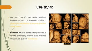 78 USG 3D/ 4D
• No modo 3D são adquiridas múltiplas
imagens no modo B, tornando possível a
avaliação volumétrica e reconstrução em
outros planos
• No modo 4D (que conta o tempo como a
quarta dimensão) mostra essas mesmas
imagens, só que em movimento
Figura 48
 