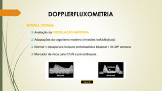 80
DOPPLERFLUXOMETRIA
• ARTÉRIA UTERINA
 Avaliação da CIRCULAÇÃO MATERNA
 Adaptações do organismo materno (invasões trofoblásticas)
 Normal = desaparece incisura protodiastólica bilateral > 24-26ª semana
 Marcador de risco para CIUR e pré eclâmpsia.
Figura 49
 
