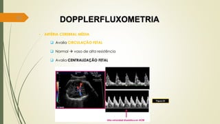 82
DOPPLERFLUXOMETRIA
• ARTÉRIA CEREBRAL MÉDIA
 Avalia CIRCULAÇÃO FETAL
 Normal  vaso de alta resistência
 Avalia CENTRALIZAÇÃO FETAL
Figura 53
 