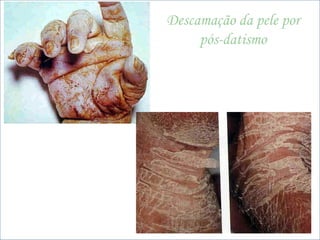 BNLago
beatrizmedpuc@pucrs.br
Descamação da pele por
pós-datismo
 