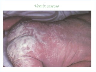 BNLago
beatrizmedpuc@pucrs.br
Vernix caseoso
 