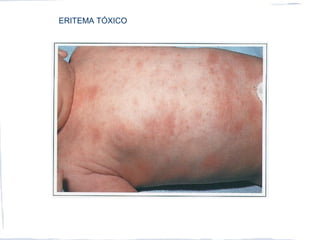 ERITEMA TÓXICO
 