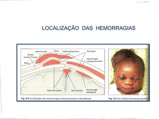 LOCALIZAÇÃO DAS HEMORRAGIAS
 