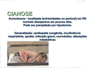 CIANOSECIANOSE
Acrocianose - localizada (extremidades ou perioral) em RNAcrocianose - localizada (extremidades ou perioral) em RN
normais desaparece em poucos dias.normais desaparece em poucos dias.
Pode ser precipitada por hipotermia.Pode ser precipitada por hipotermia.
Generalizada: cardiopatia congênita, insuficiênciaGeneralizada: cardiopatia congênita, insuficiência
respiratória, apnéia, infecção grave, convulsões, alteraçõesrespiratória, apnéia, infecção grave, convulsões, alterações
metabólicasmetabólicas
 