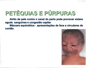PETÉQUIAS E PÚRPURASPETÉQUIAS E PÚRPURAS
Atrito da pele contra o canal do parto pode provocar estaseAtrito da pele contra o canal do parto pode provocar estase
aguda sanguínea e congestão capilaraguda sanguínea e congestão capilar
Máscara equimótica– apresentações de face e circulares deMáscara equimótica– apresentações de face e circulares de
cordãocordão
 
