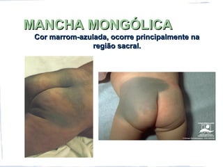 MANCHA MONGÓLICAMANCHA MONGÓLICA
Cor marrom-azulada, ocorre principalmente naCor marrom-azulada, ocorre principalmente na
região sacral.região sacral.
 