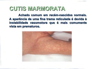 CUTIS MARMORATACUTIS MARMORATA
Achado comum em recém-nascidos normais.Achado comum em recém-nascidos normais.
A aparência de uma fina trama reticulada é devida àA aparência de uma fina trama reticulada é devida à
instabilidade vasomotora que é mais comumenteinstabilidade vasomotora que é mais comumente
vista em prematuros.vista em prematuros.
 