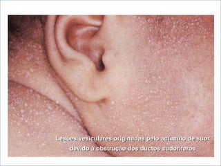 BNLago
beatrizmedpuc@pucrs.br
Lesões vesiculares originadas pelo acúmulo de suorLesões vesiculares originadas pelo acúmulo de suor
devido à obstrução dos ductos sudoríferosdevido à obstrução dos ductos sudoríferos
 