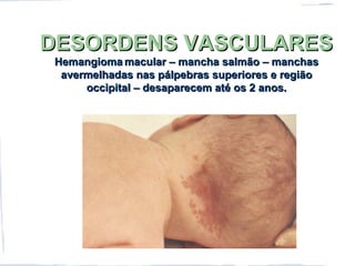 DESORDENS VASCULARESDESORDENS VASCULARES
HemangiomaHemangioma macular – mancha salmão – manchasmacular – mancha salmão – manchas
avermelhadas nas pálpebras superiores e regiãoavermelhadas nas pálpebras superiores e região
occipital – desaparecem até os 2 anos.occipital – desaparecem até os 2 anos.
 