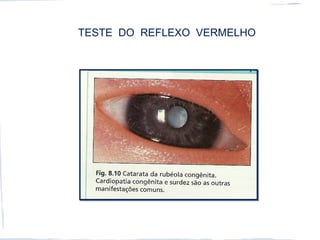 TESTE DO REFLEXO VERMELHO
 