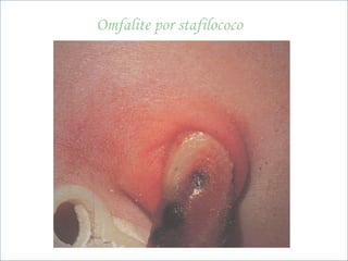 BNLago
beatrizmedpuc@pucrs.br
Omfalite por stafilococo
 