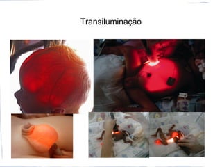 Transiluminação
 