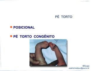 PÉ TORTO
POSICIONAL
PÉ TORTO CONGÊNITO
BNLago
beatrizmedpuc@pucrs.br
 