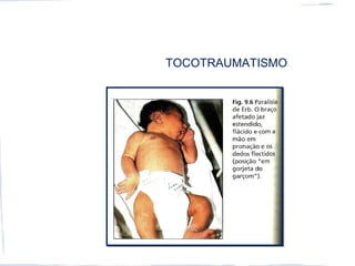 TOCOTRAUMATISMO
 