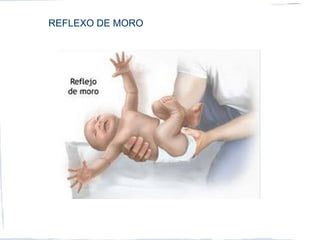 REFLEXO DE MORO
 
