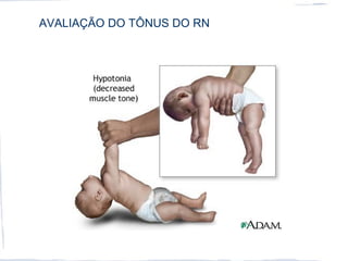AVALIAÇÃO DO TÔNUS DO RN
 
