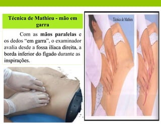 Técnica de Mathieu - mão em
garra
Com as mãos paralelas e
os dedos “em garra”, o examinador
avalia desde a fossa ilíaca direita, a
borda inferior do fígado durante as
inspirações.
 