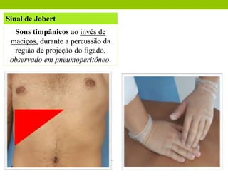 Sinal de Jobert
Sons timpânicos ao invés de
maciços, durante a percussão da
região de projeção do fígado,
observado em pneumoperitôneo.
 