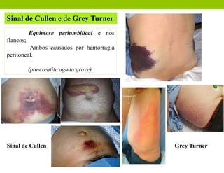 Sinal de Cullen e de Grey Turner
Equimose periumbilical e nos
flancos;
Ambos causados por hemorragia
peritoneal.
(pancreatite aguda grave).
Sinal de Cullen Grey Turner
 