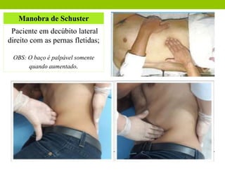 Manobra de Schuster
Paciente em decúbito lateral
direito com as pernas fletidas;
OBS: O baço é palpável somente
quando aumentado.
 