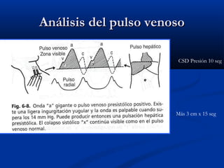 Análisis del pulso venosoAnálisis del pulso venoso
CSD Presión 10 seg
Más 3 cm x 15 seg
 