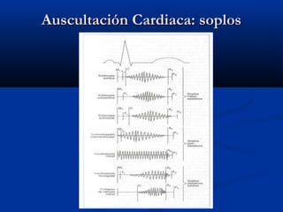 Auscultación Cardiaca: soplosAuscultación Cardiaca: soplos
 