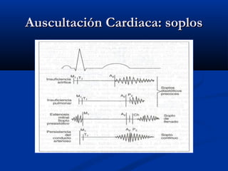 Auscultación Cardiaca: soplosAuscultación Cardiaca: soplos
 