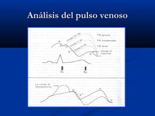 Análisis del pulso venosoAnálisis del pulso venoso
 