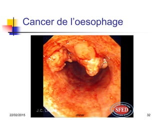 Cancer de l’oesophage
22/02/2015 32chinar
 