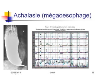 Achalasie (mégaoesophage)
22/02/2015 35chinar
 