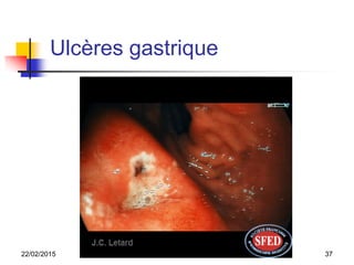 Ulcères gastrique
22/02/2015 37chinar
 