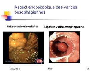 Varices cardiotubérositaires
Aspect endoscopique des varices
oesophagiennes
22/02/2015 38chinar
 