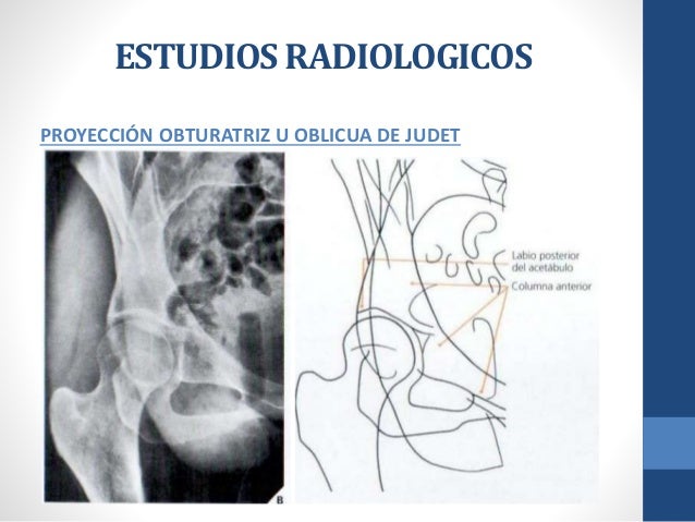 Semiogia de cadera - Ortopedia y Traumatologia