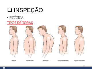  INSPEÇÃO
• ESTÁTICA
TIPOS DE TÓRAX
26
 