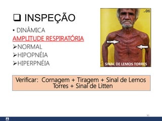  INSPEÇÃO
• DINÂMICA
AMPLITUDE RESPIRATÓRIA
NORMAL
HIPOPNÉIA
HIPERPNÉIA
Verificar: Cornagem + Tiragem + Sinal de Lemos
Torres + Sinal de Litten
30
SINAL DE LEMOS TORRES
 
