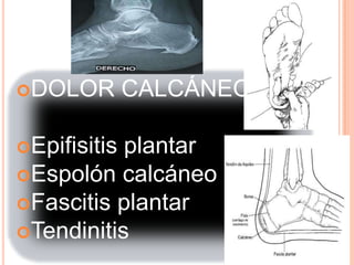 DOLOR        CALCÁNEO:

Epifisitisplantar
Espolón calcáneo
Fascitis plantar
Tendinitis
 