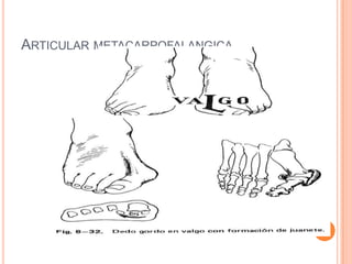 ARTICULAR METACARPOFALANGICA
 