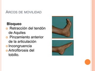 ARCOS DE MOVILIDAD

Bloqueo
 Retracción del tendón
  de Aquiles
 Pinzamiento anterior
  de la articulación
 Incongruencia
 Artrofibrosis del
  tobillo.
 