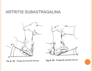 ARTRITIS SUBASTRAGALINA
 