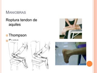MANIOBRAS
Roptura tendon de
 aquiles

 Thompson

 Surco
 