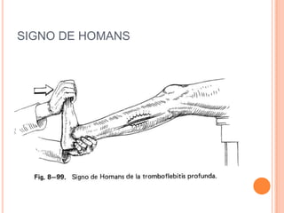 SIGNO DE HOMANS
 