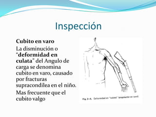 Inspección
Cubito en varo
La disminución o
“deformidad en
culata” del Angulo de
carga se denomina
cubito en varo, causado
por fracturas
supracondilea en el niño.
Mas frecuente que el
cubito valgo
 
